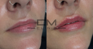 Aumento de labios gemma moyá ob