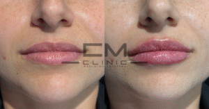 aumento de labios miriam rodríguez garcía fr