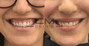 Sonrisa gingival