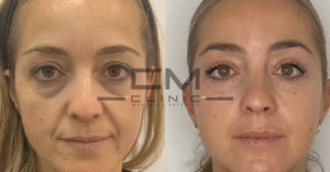 ojeras raquel álvarez fr
