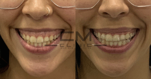Sonrisa gingival